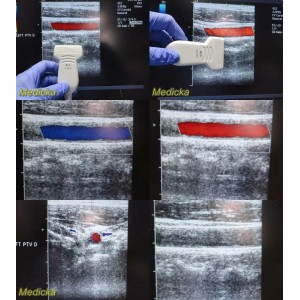 https://www.themedicka.com/10061-111684-thickbox/acuson-model-8l5-linear-array-ultrasound-transducer-probe-24844.jpg