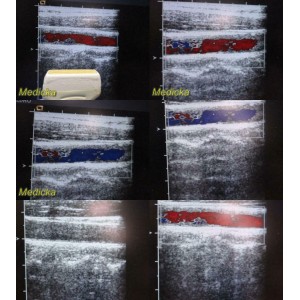 https://www.themedicka.com/10220-113515-thickbox/acuson-8l5-linear-array-ultrasound-transducer-probe-tested-working-24829.jpg