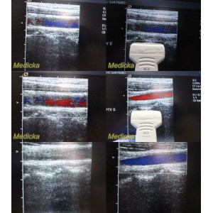 https://www.themedicka.com/10225-113575-thickbox/acuson-model-8l5-linear-array-ultrasound-transducer-probe-24824.jpg