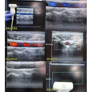 https://www.themedicka.com/10235-113695-thickbox/acuson-15l8w-linear-array-ultrasound-transducer-probe-p-n-08241113-24728.jpg