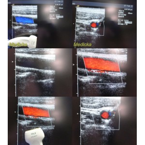 https://www.themedicka.com/14918-167446-thickbox/acuson-15l8-ergo-linear-array-ultrasound-transducer-probe-23949.jpg