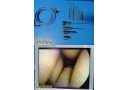 DYONICS 3626 Rigid Endoscope & ECTRA II 4550 Tunnel Ligament Repair Instru~36881